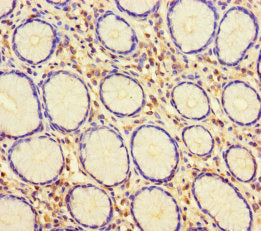 Immunohistochemistry of paraffin-embedded human gastric cancer using HUS1 Antibody at dilution of 1:100Rabbit anti-Human HUS1 Polyclonal Antibody