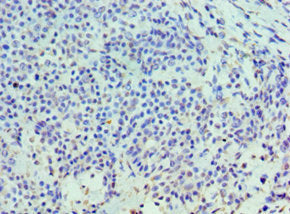 Immunohistochemistry of paraffin-embedded human breast cancer using HYAL3 Antibody at dilution of 1:100Rabbit anti-Human HYAL3 Polyclonal Antibody