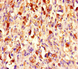 Immunohistochemistry of paraffin-embedded human melanoma using CHD4 Antibody at dilution of 1:100Rabbit anti-Human CHD4 Polyclonal Antibody