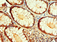 Immunohistochemistry of paraffin-embedded human colon cancer using IDH1 Antibody at dilution of 1:100Rabbit anti-Human IDH1 Polyclonal Antibody