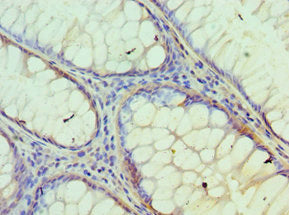 Immunohistochemistry of paraffin-embedded human colon cancer using IDH2 Antibody at dilution of 1:100Rabbit anti-Human IDH2 Polyclonal Antibody