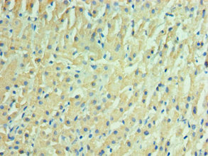 Immunohistochemistry of paraffin-embedded human liver cancer using IDH2 Antibody at dilution of 1:100Rabbit anti-Human IDH2 Polyclonal Antibody