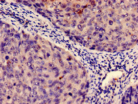 Immunohistochemistry analysis of human cervical cancer using the antibody at dilution of 1:100Rabbit anti-Human IDO1 Polyclonal Antibody
