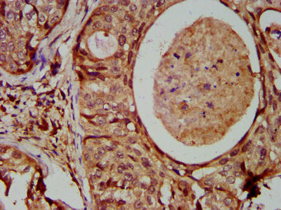IHC image of IFIT2 Antibody diluted at 1:600 and staining in paraffin-embedded human cervical cancer performed on a Leica BondTM system. After dewaxing and hydration, antigen retrieval was mediated by high pressure in a citrate buffer (pH 6.0). Section was blocked with 10% normal goat serum 30min at RT. Then primary antibody (1% BSA) was incubated at 4°C overnight. The primary is detected by a biotinylated secondary antibody and visualized using an HRP conjugated SP system.Rabbit anti-Human IFIT2 Polyclonal Antibody