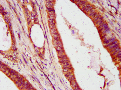 IHC image of IFIT2 Antibody diluted at 1:600 and staining in paraffin-embedded human colon cancer performed on a Leica BondTM system. After dewaxing and hydration, antigen retrieval was mediated by high pressure in a citrate buffer (pH 6.0). Section was blocked with 10% normal goat serum 30min at RT. Then primary antibody (1% BSA) was incubated at 4°C overnight. The primary is detected by a biotinylated secondary antibody and visualized using an HRP conjugated SP system.Rabbit anti-Human IFIT2 Polyclonal Antibody