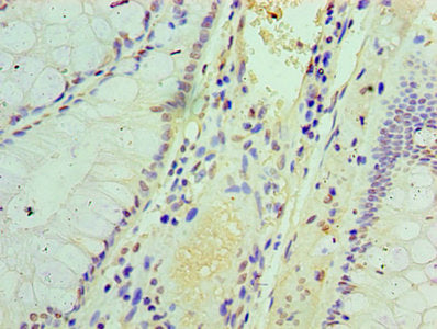 Immunohistochemistry of paraffin-embedded human colon cancer using IFIT3 Antibody at dilution of 1:100Rabbit anti-Human IFIT3 Polyclonal Antibody