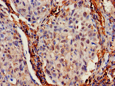 IHC image of IFITM2 Antibody diluted at 1:700 and staining in paraffin-embedded human lung cancer performed on a Leica BondTM system. After dewaxing and hydration, antigen retrieval was mediated by high pressure in a citrate buffer (pH 6.0). Section was blocked with 10% normal goat serum 30min at RT. Then primary antibody (1% BSA) was incubated at 4°C overnight. The primary is detected by a biotinylated secondary antibody and visualized using an HRP conjugated SP system.Rabbit anti-Human IFITM2 Polyclonal Antibody