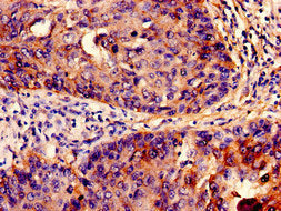Immunohistochemistry analysis of human cervical cancer using IFITM3 Antibody at dilution of 1:100Rabbit anti-Human IFITM3 Polyclonal Antibody