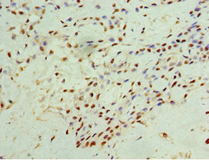 Immunohistochemistry of paraffin-embedded human breast cancer using IFNGR1 Antibody at dilution of 1:100Rabbit anti-Human IFNGR1 Polyclonal Antibody