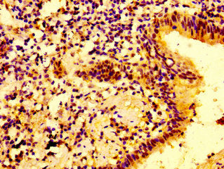 IHC image of IFNGR2 Antibody diluted at 1:100 and staining in paraffin-embedded human lung cancer performed on a Leica BondTM system. After dewaxing and hydration, antigen retrieval was mediated by high pressure in a citrate buffer (pH 6.0). Section was blocked with 10% normal goat serum 30min at RT. Then primary antibody (1% BSA) was incubated at 4°C overnight. The primary is detected by a biotinylated secondary antibody and visualized using an HRP conjugated SP system.Rabbit anti-Human IFNGR2 Polyclonal Antibody