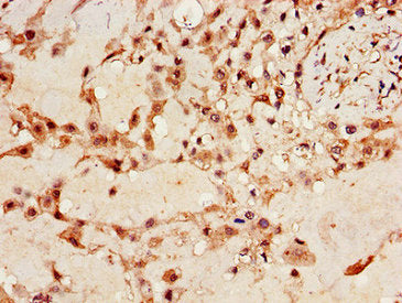 Immunohistochemistry of paraffin-embedded human placenta tissue using IGF2BP3 Antibody at dilution of 1:100Rabbit anti-Human IGF2BP3 Polyclonal Antibody