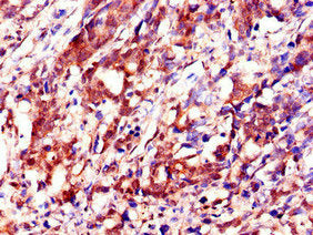 Immunohistochemistry of paraffin-embedded human gastric cancer using IGF2BP3 Antibody at dilution of 1:100Rabbit anti-Human IGF2BP3 Polyclonal Antibody
