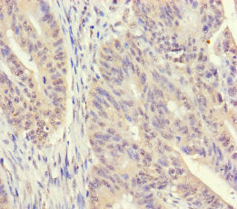 Immunohistochemistry of paraffin-embedded human colon cancer using SRM Antibody at dilution of 1:100Rabbit anti-Human SRM Polyclonal Antibody