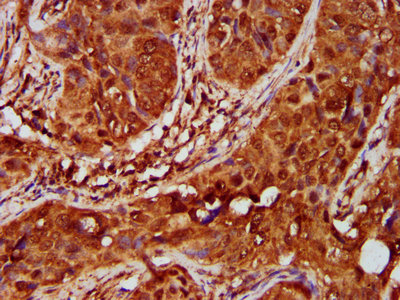 IHC image of ELP1 Antibody diluted at 1:600 and staining in paraffin-embedded human cervical cancer performed on a Leica BondTM system. After dewaxing and hydration, antigen retrieval was mediated by high pressure in a citrate buffer (pH 6.0). Section was blocked with 10% normal goat serum 30min at RT. Then primary antibody (1% BSA) was incubated at 4°C overnight. The primary is detected by a biotinylated secondary antibody and visualized using an HRP conjugated SP system.Rabbit anti-Human ELP1 Polyclonal Antibody
