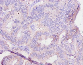 Immunohistochemistry of paraffin-embedded human colon cancer using IL12B Antibody at dilution of 1:10Rabbit anti-Ovis aries (Sheep) IL12B Polyclonal Antibody