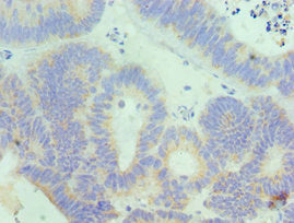Immunohistochemistry of paraffin-embedded human colon cancer using the antibody at dilution of 1:100
