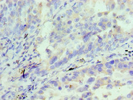 Immunohistochemistry of paraffin-embedded human lung cancer using IL18RAP Antibody at dilution of 1:100