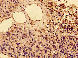 Immunohistochemistry of paraffin-embedded human glioma using IL2RA Antibody at dilution of 1:100Rabbit anti-Human IL2RA Polyclonal Antibody
