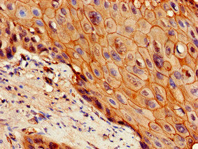 Immunohistochemistry of paraffin-embedded human cervical cancer using IL7R Antibody at dilution of 1:100Rabbit anti-Human IL7R Polyclonal Antibody