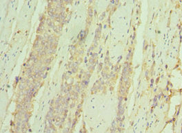 Immunohistochemistry of paraffin-embedded human colon cancer using IL7R Antibody at dilution of 1:100Rabbit anti-Human IL7R Polyclonal Antibody