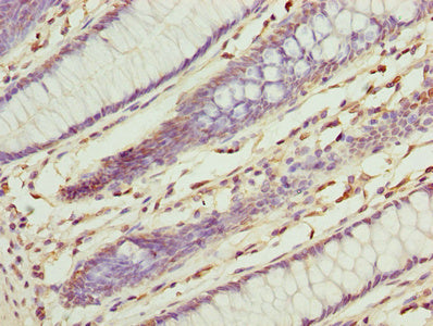 Immunohistochemistry of paraffin-embedded human colon cancer using ILVBL Antibody at dilution of 1:100Rabbit anti-Human ILVBL Polyclonal Antibody