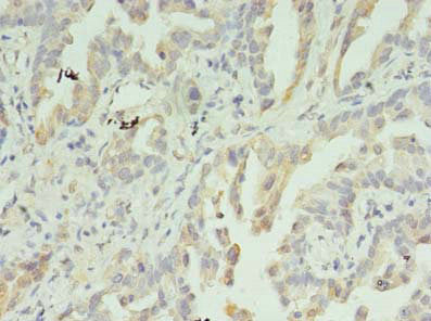 Immunohistochemistry of paraffin-embedded human lung cancer using IMPDH2 Antibody at dilution of 1:100Rabbit anti-Human IMPDH2 Polyclonal Antibody