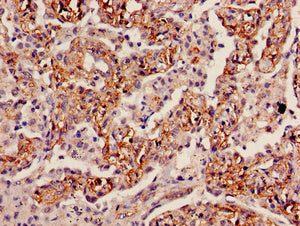 Immunohistochemistry of paraffin-embedded human lung cancer using INMT Antibody at dilution of 1:100