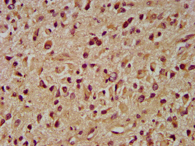 IHC image of the antibody diluted at 1:400 and staining in paraffin-embedded human glioma performed on a Leica BondTM system. After dewaxing and hydration, antigen retrieval was mediated by high pressure in a citrate buffer (pH 6.0). Section was blocked with 10% normal goat serum 30min at RT. Then primary antibody (1% BSA) was incubated at 4°C overnight. The primary is detected by a biotinylated secondary antibody and visualized using an HRP conjugated SP system.
