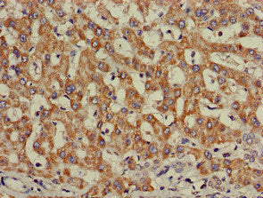 Immunohistochemistry of paraffin-embedded human liver cancer using the antibody at dilution of 1:100