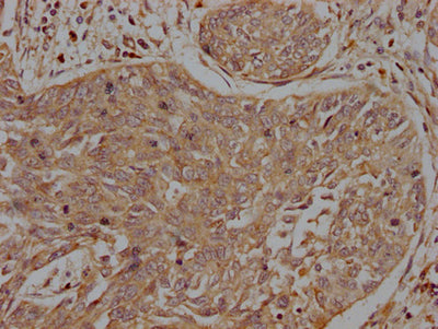IHC image of INSRR Antibody diluted at 1:200 and staining in paraffin-embedded human cervical cancer performed on a Leica BondTM system. After dewaxing and hydration, antigen retrieval was mediated by high pressure in a citrate buffer (pH 6.0). Section was blocked with 10% normal goat serum 30min at RT. Then primary antibody (1% BSA) was incubated at 4°C overnight. The primary is detected by a biotinylated secondary antibody and visualized using an HRP conjugated SP system.Rabbit anti-Human INSRR Polyclonal Antibody
