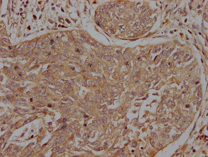 IHC image of INSRR Antibody diluted at 1:200 and staining in paraffin-embedded human cervical cancer performed on a Leica BondTM system. After dewaxing and hydration, antigen retrieval was mediated by high pressure in a citrate buffer (pH 6.0). Section was blocked with 10% normal goat serum 30min at RT. Then primary antibody (1% BSA) was incubated at 4°C overnight. The primary is detected by a biotinylated secondary antibody and visualized using an HRP conjugated SP system.Rabbit anti-Human INSRR Polyclonal Antibody
