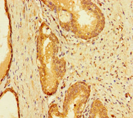 Immunohistochemistry of paraffin-embedded human prostate cancer using INTS9 Antibody at dilution of 1:100