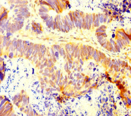 Immunohistochemistry of paraffin-embedded human ovarian cancer using INTS9 Antibody at dilution of 1:100