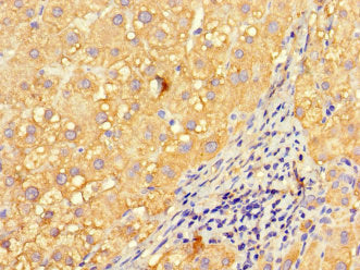 Immunohistochemistry of paraffin-embedded human liver cancer using INVS Antibody at dilution of 1:100