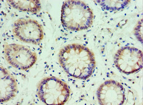 Immunohistochemistry of paraffin-embedded human colon cancer using IRF2 Antibody at dilution of 1:100