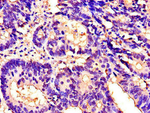 Immunohistochemistry of paraffin-embedded human colon cancer using the antibody at dilution of 1:100