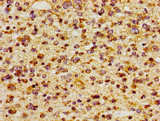 Immunohistochemistry of paraffin-embedded human glioma using ITGAV Antibody at dilution of 1:100