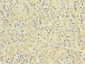 Immunohistochemistry of paraffin-embedded human lung cancer using ITGAX Antibody at dilution of 1:100