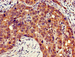 Immunohistochemistry of paraffin-embedded human pancreatic cancer using ITGB4 Antibody at dilution of 1:100