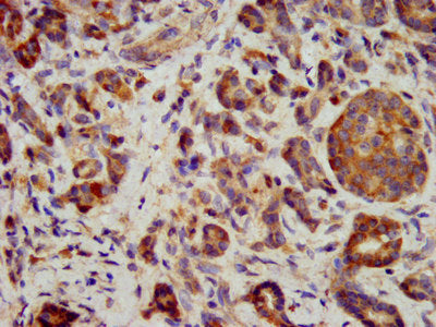 IHC image of ITGB6 Antibody diluted at 1:400 and staining in paraffin-embedded human pancreatic cancer performed on a Leica BondTM system. After dewaxing and hydration, antigen retrieval was mediated by high pressure in a citrate buffer (pH 6.0). Section was blocked with 10% normal goat serum 30min at RT. Then primary antibody (1% BSA) was incubated at 4°C overnight. The primary is detected by a biotinylated secondary antibody and visualized using an HRP conjugated SP system.