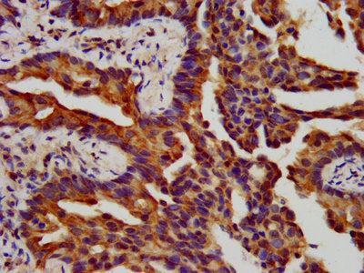 IHC image of ITGB6 Antibody diluted at 1:400 and staining in paraffin-embedded human lung cancer performed on a Leica BondTM system. After dewaxing and hydration, antigen retrieval was mediated by high pressure in a citrate buffer (pH 6.0). Section was blocked with 10% normal goat serum 30min at RT. Then primary antibody (1% BSA) was incubated at 4°C overnight. The primary is detected by a biotinylated secondary antibody and visualized using an HRP conjugated SP system.