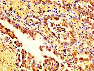 IHC image of MSN Antibody diluted at 1:200 and staining in paraffin-embedded human lung cancer performed on a Leica BondTM system. After dewaxing and hydration, antigen retrieval was mediated by high pressure in a citrate buffer (pH 6.0). Section was blocked with 10% normal goat serum 30min at RT. Then primary antibody (1% BSA) was incubated at 4°C overnight. The primary is detected by a biotinylated secondary antibody and visualized using an HRP conjugated SP system.Rabbit anti-Human MSN Polyclonal Antibody