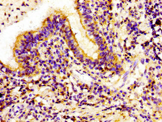 Immunohistochemistry of paraffin-embedded human lung cancer using IVL Antibody at dilution of 1:100