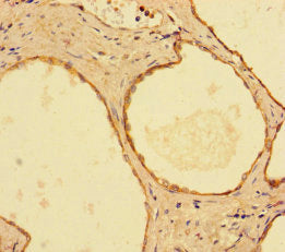 Immunohistochemistry of paraffin-embedded human prostate cancer using IMPDH2 Antibody at dilution of 1:100Rabbit anti-Human IMPDH2 Polyclonal Antibody