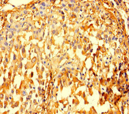 Immunohistochemistry of paraffin-embedded human lung cancer using IMPDH2 Antibody at dilution of 1:100Rabbit anti-Human IMPDH2 Polyclonal Antibody