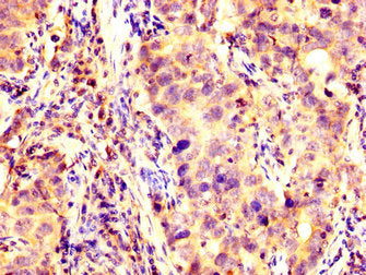 IHC image of KCNAB1 Antibody diluted at 1:200 and staining in paraffin-embedded human pancreatic cancer performed on a Leica BondTM system. After dewaxing and hydration, antigen retrieval was mediated by high pressure in a citrate buffer (pH 6.0). Section was blocked with 10% normal goat serum 30min at RT. Then primary antibody (1% BSA) was incubated at 4°C overnight. The primary is detected by a biotinylated secondary antibody and visualized using an HRP conjugated SP system.