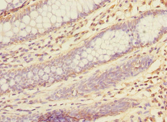 Immunohistochemistry of paraffin-embedded human colon cancer using KHK Antibody at dilution of 1:100