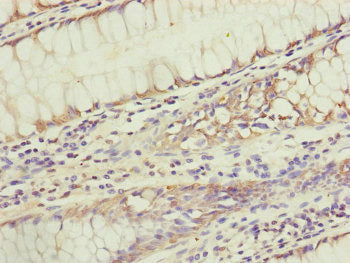 Immunohistochemistry of paraffin-embedded human colon cancer using KIAA0391 Antibody at dilution of 1:100
