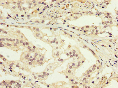 IHC image of GDI1 Antibody diluted at 1:200 and staining in paraffin-embedded human prostate cancer performed on a Leica BondTM system. After dewaxing and hydration, antigen retrieval was mediated by high pressure in a citrate buffer (pH 6.0). Section was blocked with 10% normal goat serum 30min at RT. Then primary antibody (1% BSA) was incubated at 4°C overnight. The primary is detected by a biotinylated secondary antibody and visualized using an HRP conjugated SP system.Rabbit anti-Human GDI1 Polyclonal Antibody