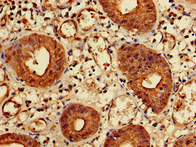 Immunohistochemistry of paraffin-embedded human colon cancer using KIDINS220 Antibody at dilution of 1:100